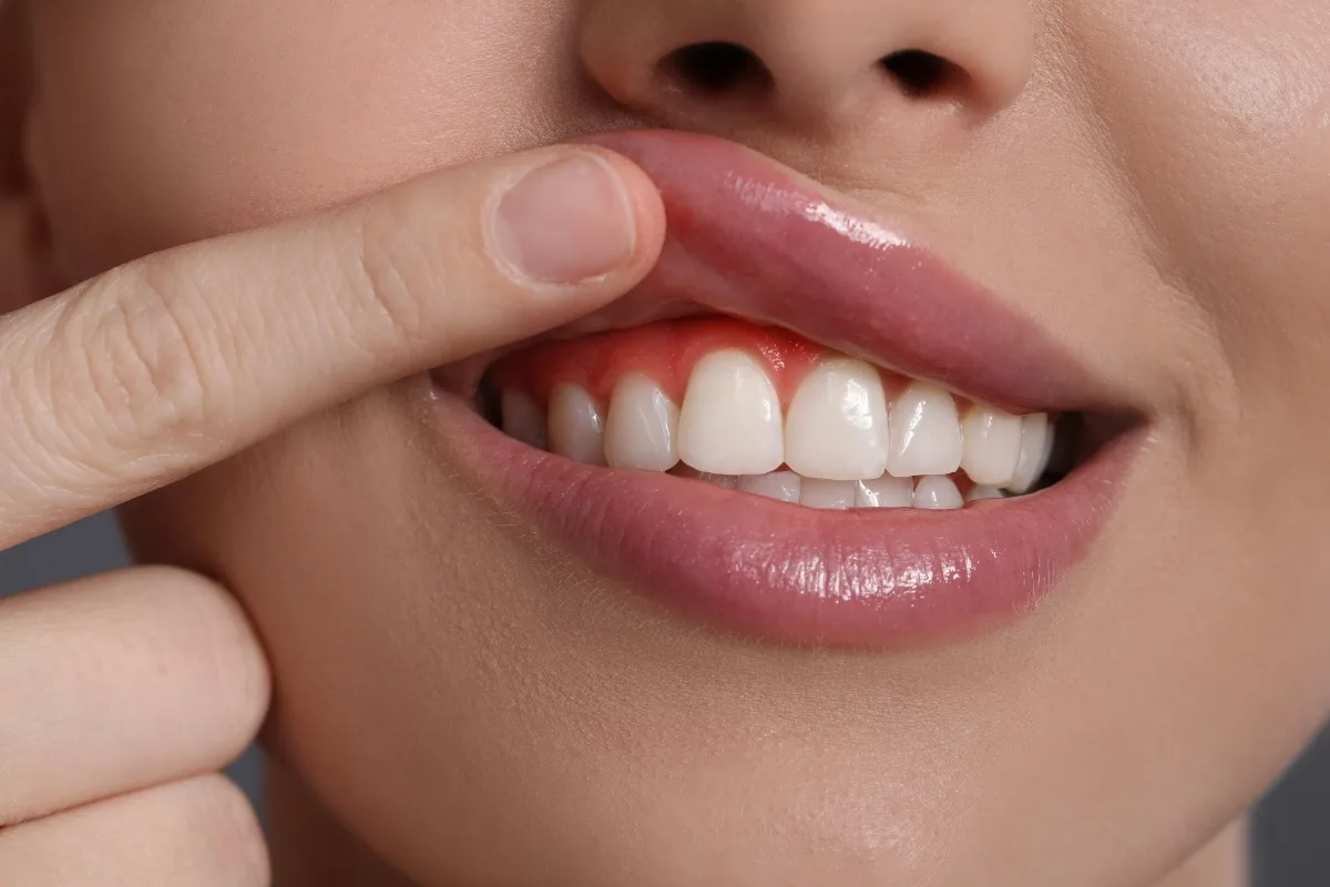 Gum Treatment
